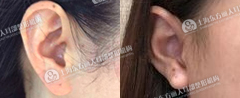 耳垂畸形的5种类型