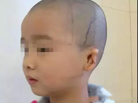 数年艰辛求医，琪琪成功造耳返回学校——记录一个真实的耳畸形患者造耳案例