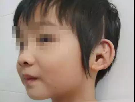 数年艰辛求医，琪琪成功造耳返回学校——记录一个真实的耳畸形患者造耳案例