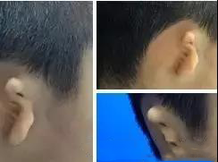 家长注意！先天性耳畸形对孩子有哪些危害，你一定要知道！