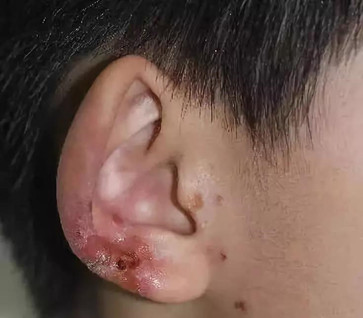 寒冷冬季，四点告诉你为什么要保护我们的耳朵