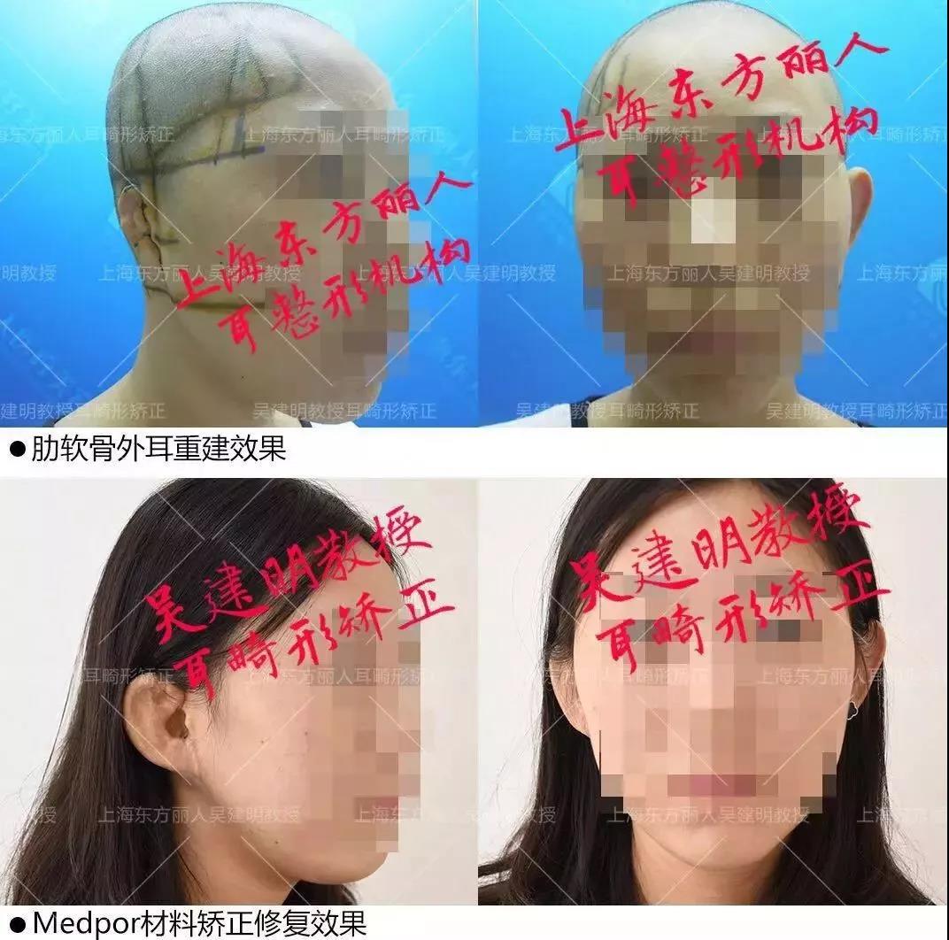 肋软骨手术失败后，我的耳朵还有救吗？