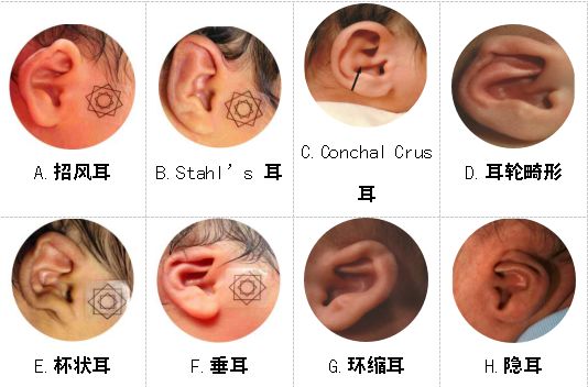 关注耳廓畸形，从婴儿做起！